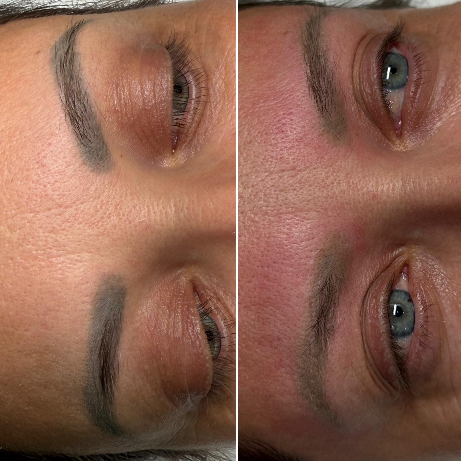 Îndepărtare tatuaj laser