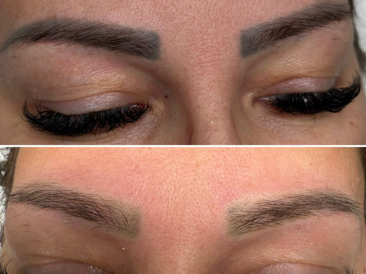 Îndepărtare tatuaj laser