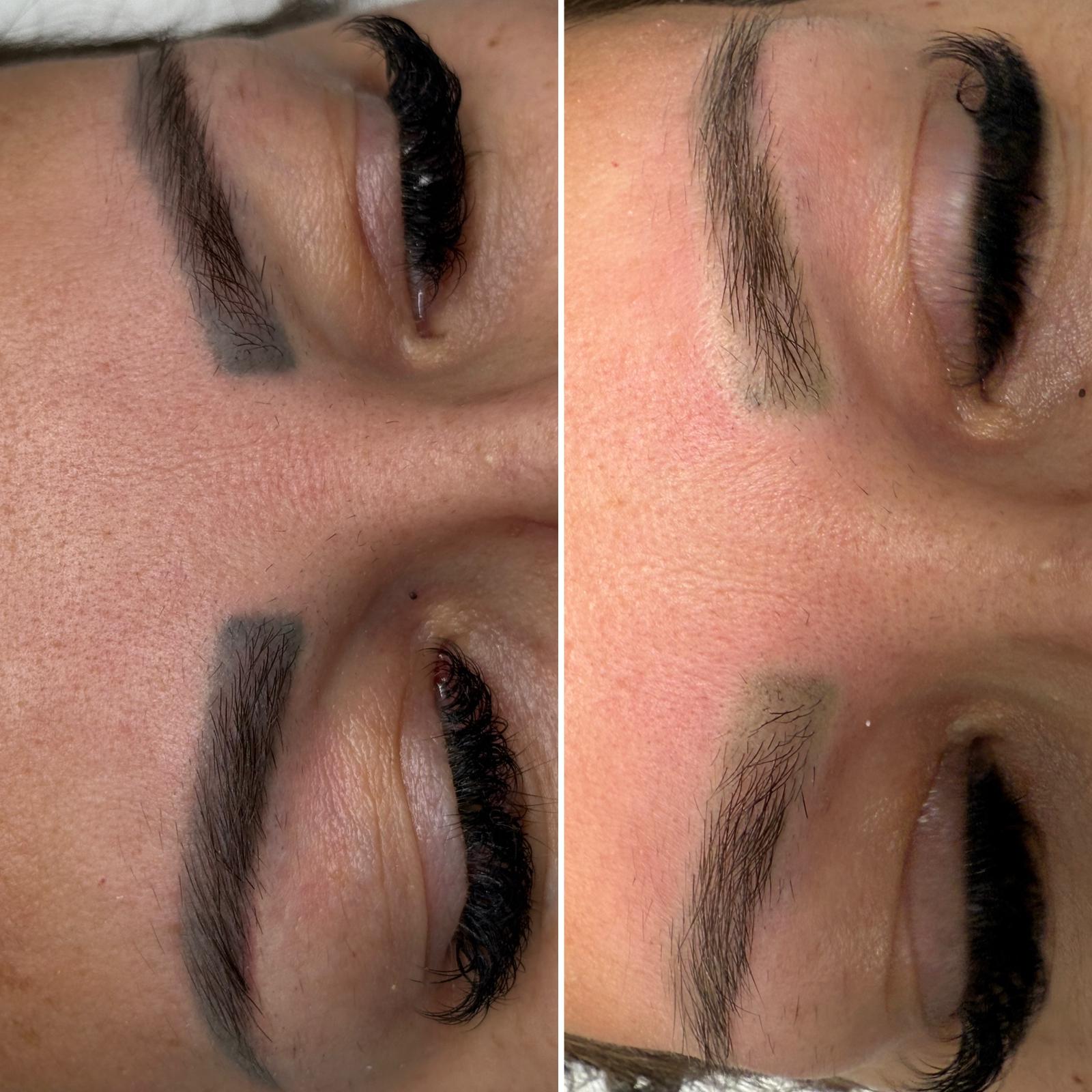 Îndepărtare tatuaj laser