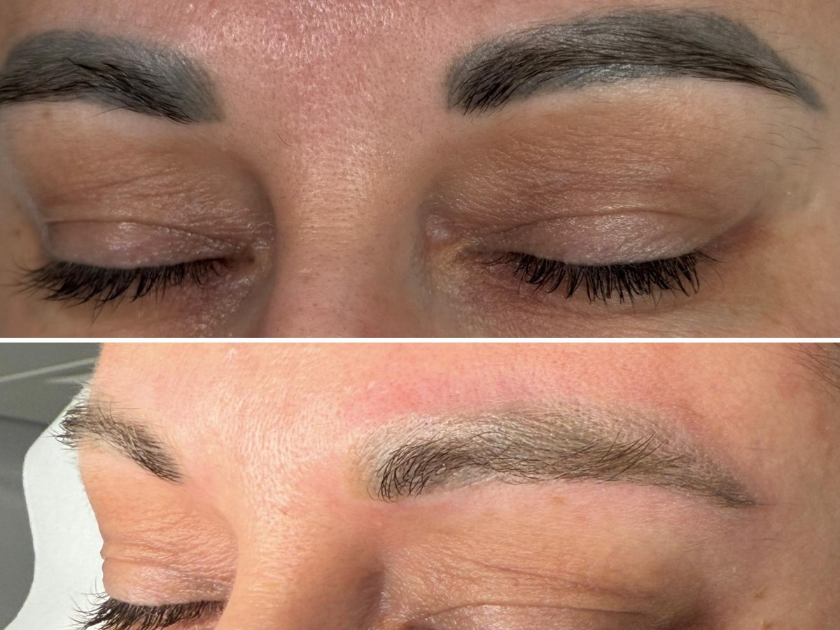 Îndepărtare tatuaj laser