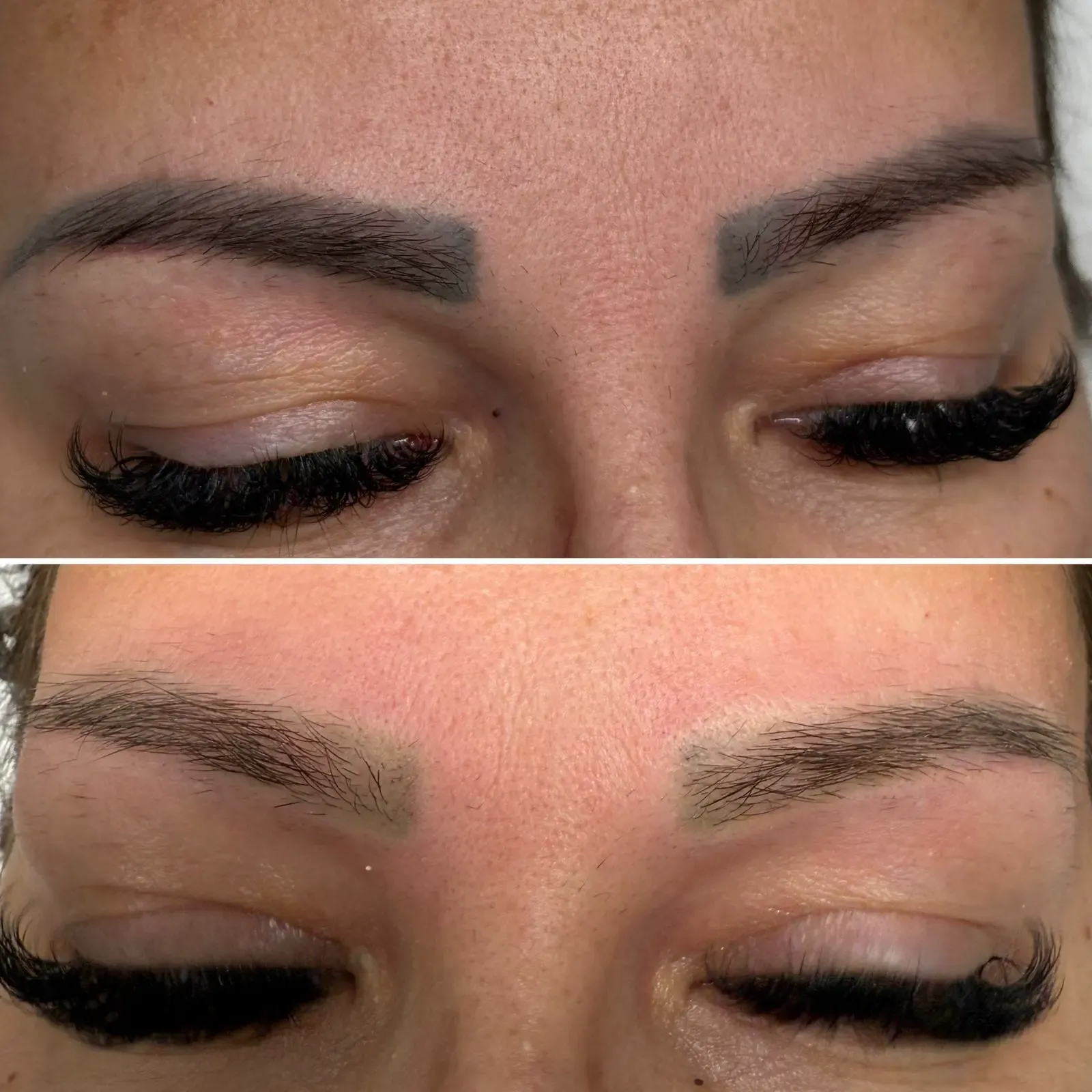 Indepartare pigment cu laser Ploiesti - evaluare initiala