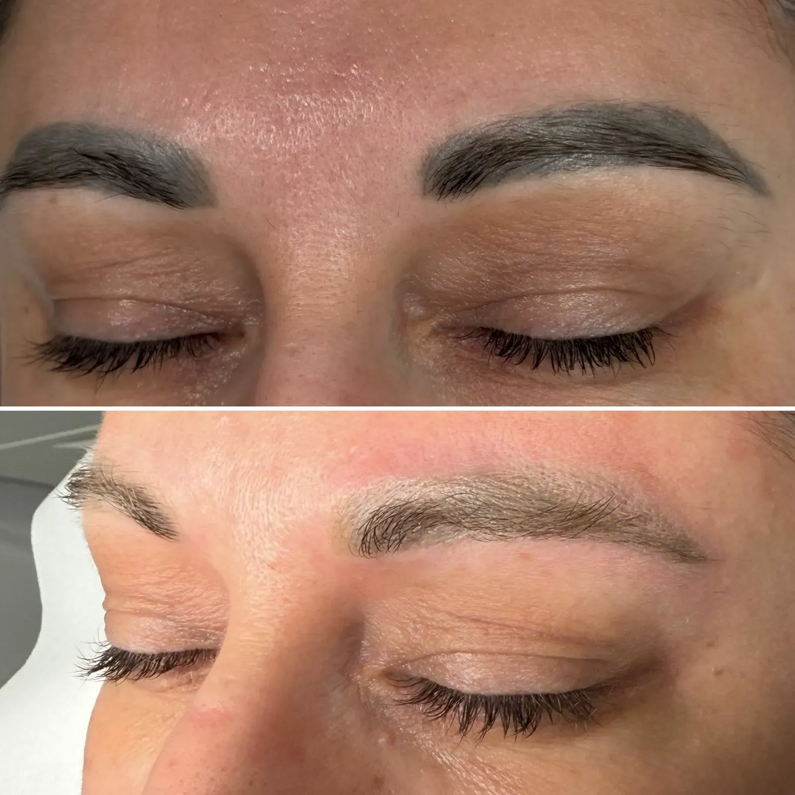 Indepartare pigment cu laser Ploiesti - sedinta in cabinet