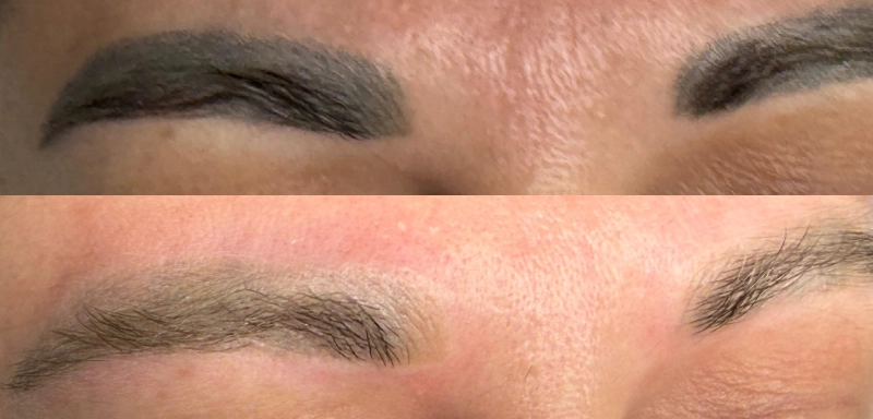 Îndepărtare Tatuaj Laser